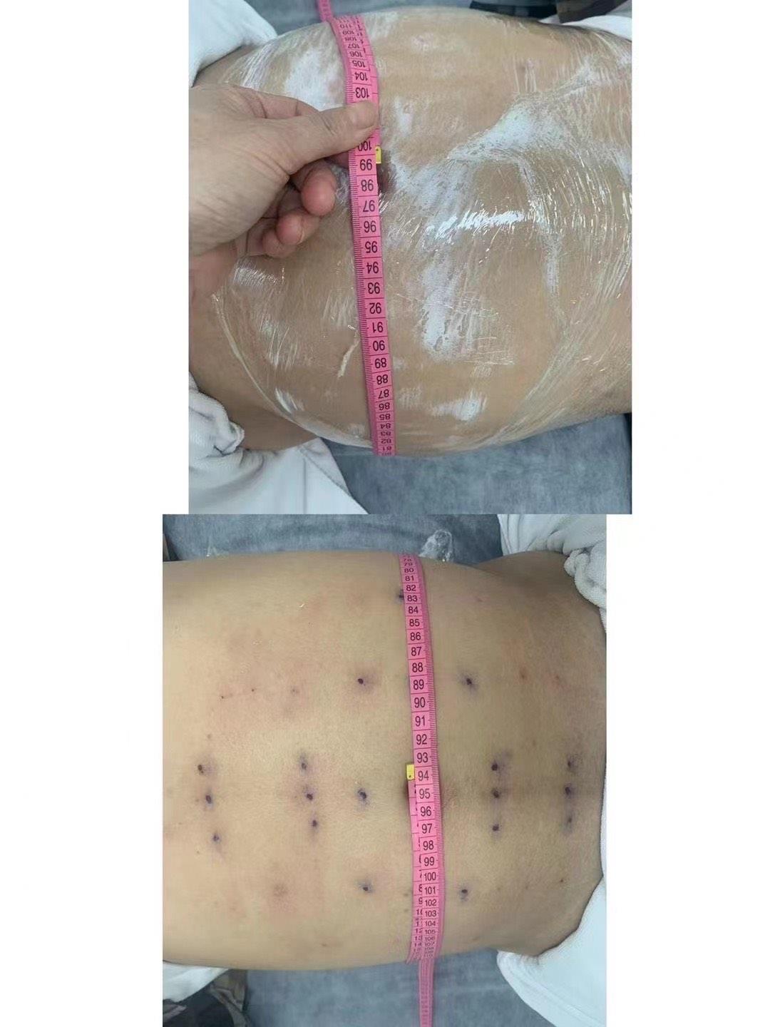 开封埋线减肥培训 一对一教学