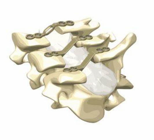 椎板固定板系统