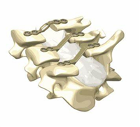 椎板固定板系统