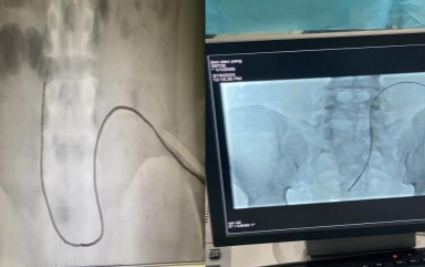 YW-2065视频腹膜透析置管镜