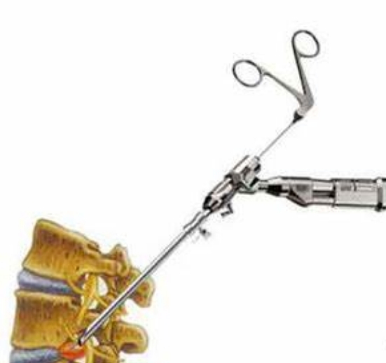 RESP-B、RESP-C椎间孔镜