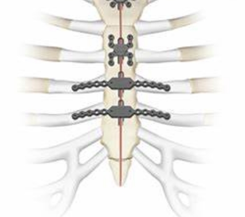 肋骨固定系统泰济