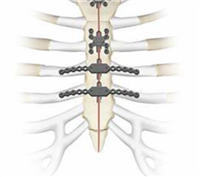 肋骨固定系统泰济
