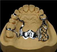 弯制支架胶连可摘局部义齿 定制式活动义齿