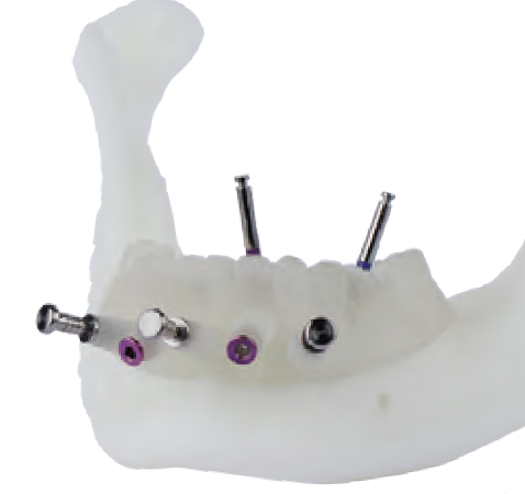 基牙支持式定制式牙科种植导板