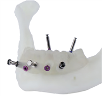 基牙支持式定制式牙科种植导板