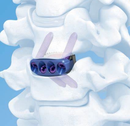 钛涂层自稳型颈椎前路椎间融合固定系统