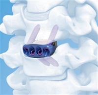 钛涂层自稳型颈椎前路椎间融合固定系统