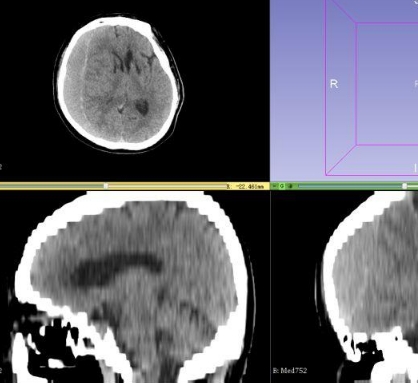 3DSkull头骨CT影像处理软件