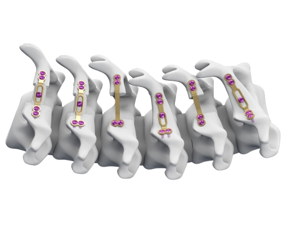 椎板固定板系统普鲁顿