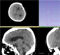 3DSkull头骨CT影像处理软件