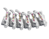 椎板固定板系统普鲁顿