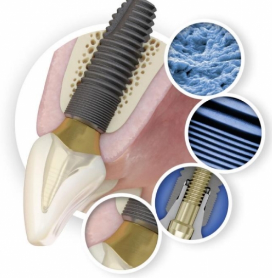 牙种植体系统麦德思贝