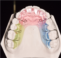 螺丝固定矫治器定制式正畸矫治器