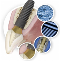 牙种植体系统麦德思贝