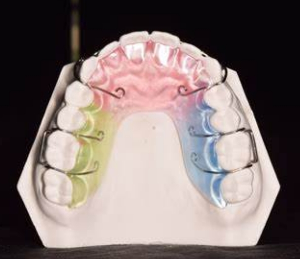 矫治保持型定制式矫治器
