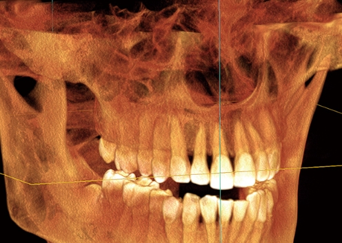 DC-PPF口腔X射线图像处理软件