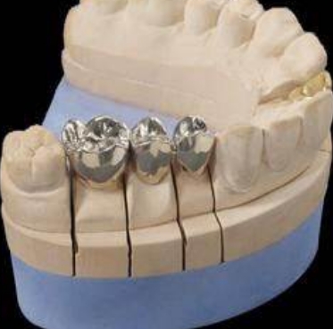可加工玻璃陶瓷全瓷冠 定制式固定义齿