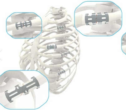 肋骨板系统贝思达