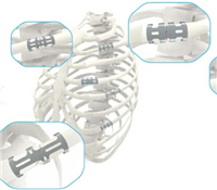 肋骨板系统贝思达