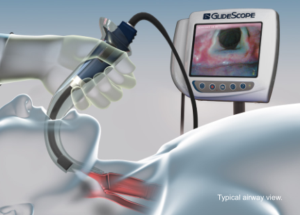 厂商美国GlideScope视频喉镜AVL Single-Use 可视视频喉镜系统