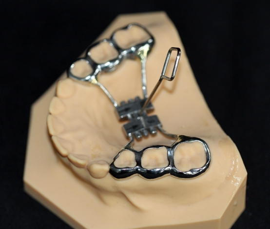 扩弓型、牙胶片型定制式矫治器