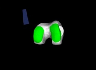 YP-T-1000膝关节置换手术导航定位系统