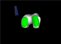 YP-T-1000膝关节置换手术导航定位系统