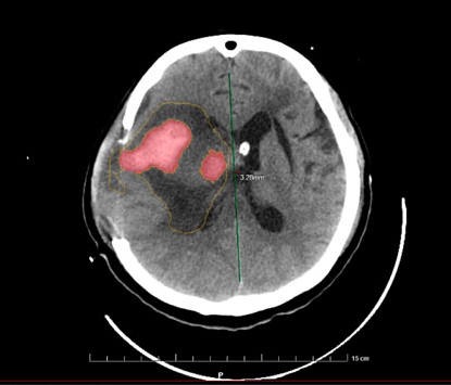 uAI-AorticDissection主动脉夹层CT血管造影图像辅助分诊软件