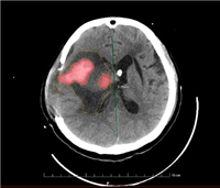 uAI-AorticDissection主动脉夹层CT血管造影图像辅助分诊软件