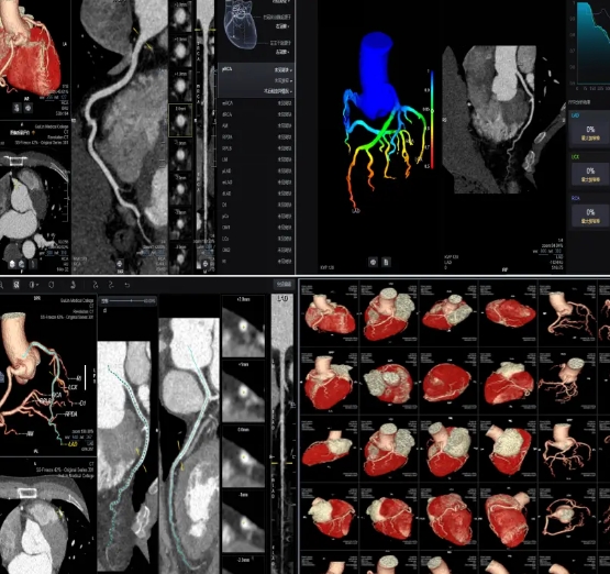 AccuLV心脏CT影像处理软件
