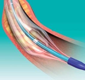 冠状动脉球囊扩张导管益心达