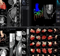 AccuLV心脏CT影像处理软件