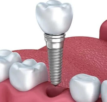 牙种植体系统天博庐德