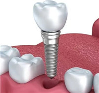 牙种植体系统天博庐德
