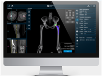 髋关节置换手术导航定位系统ROPAplasty-01