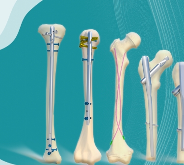 金属髓内针健力邦德