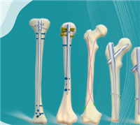 金属髓内针健力邦德