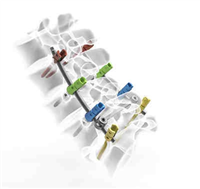 脊柱后路扩张通道组件创辰