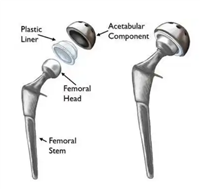 双动髋关节系统正天