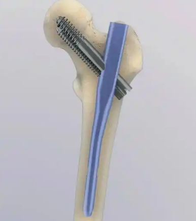 足踝髓内钉系统