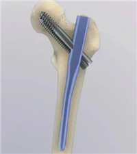 足踝髓内钉系统