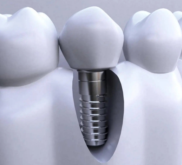 牙种植体系统睿植康