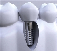 牙种植体系统睿植康