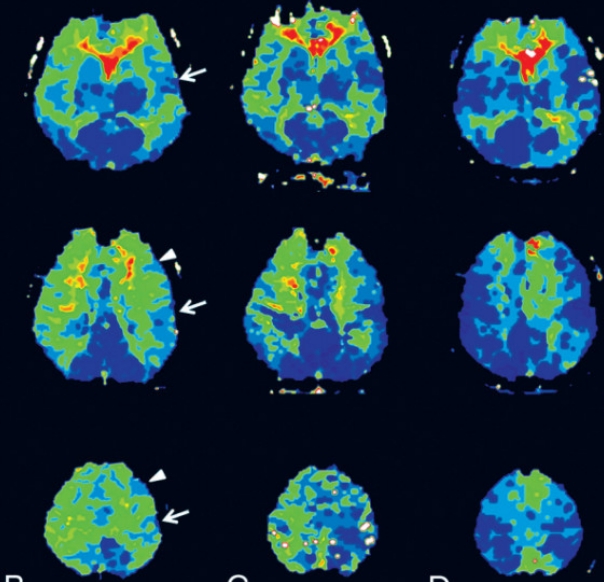 脑灌注CT影像处理软件费莎