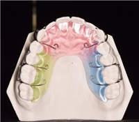 活动保持器定制式保持器
