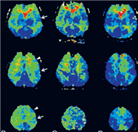 脑灌注CT影像处理软件费莎