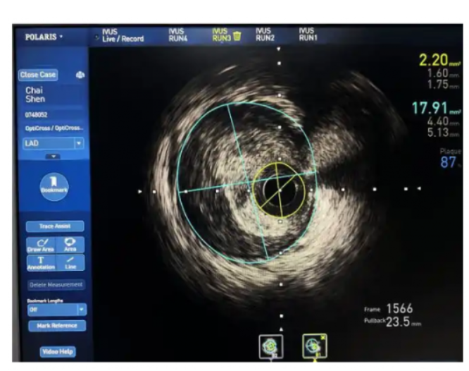 血管内超声影像处理软件InTo IVUS