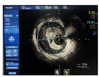 血管内超声影像处理软件InTo IVUS