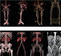 3Dlimb-vessel四肢血管CT影像处理软件价格区间